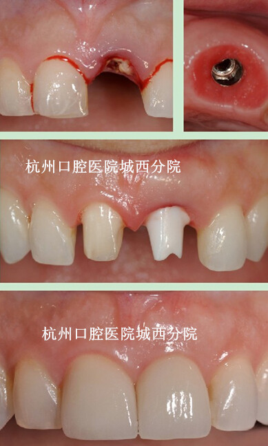 大家健康网(人类的第三副牙齿——种植牙)